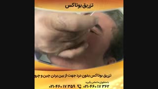 تزریق بوتاکس