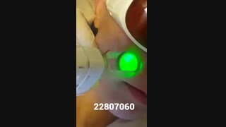 لیزر موهای زائد - کلینیک زیبایی پری سیما - 22807060