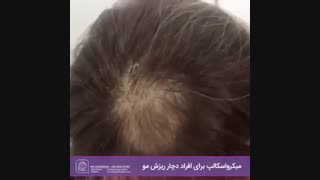 میکرواسکالپ برای افراد دچار ریزش مو