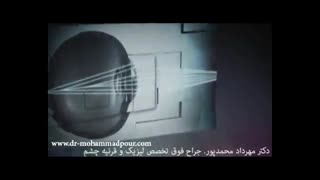 فیلم 1همه چیزدرمورد عمل لیزیک ولازک چشم09392002452دکترمهردادمحمدپورفوق تخصص لیزیک وقرنیه چشم