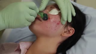 چگونه با میکرونیدلینگ زخمهای آکنه بر روی صورت را از بین ببریم ؟