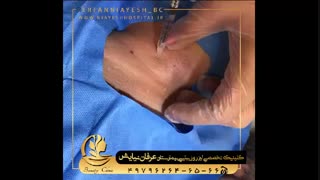 تزریق بوتاکس کامپوزیت ونیر