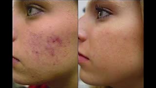 آموزش میکرونیدلینگ با درمارولر و دستگاه میکرونیدلینگ در خانه