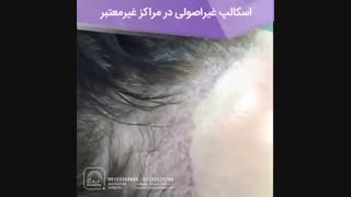 اسکالپ غیراصولی در مراکز غیرمعتبر