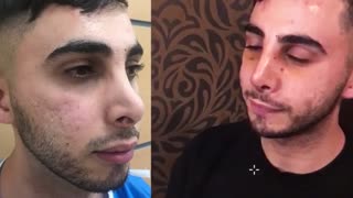 عمل ترمیم بینی