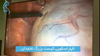لاپاراسکوپی کیست بزرگ تخمدان