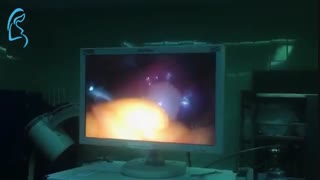 عمل جراحی حاملگی خارج از رحم