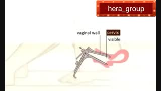 تست پاپ اسمیر