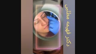 تزریق ژل به گونه رفع چین و چروک