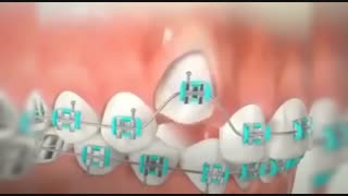 ارتودنسی دندان نیش