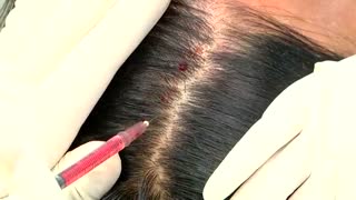 پی آر پی و میکرونیدلینگ برای رشد مو