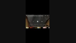 ساب سیژن گسترده با سوزن تایلور لیبراتور