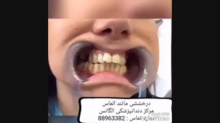 فیلم لمینیت دندان | آموزش لمینیت دندان | بهترین مارک کامپوزیت دندان | مزایای لمینیت دندان | مزایای کامپوزیت دندان