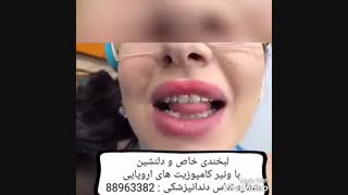 دوام ونیر کامپوزیت چقدر است | ماندگاری ونیر کامپوزیت بیشتر است یا لمینیت سرامیکی | فرق ونیر کامپوزیت با پرسلن کامپوزیت آکنه