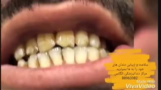 مراحل ترمیم لمینیت دندان | ترمیم ونیر کامپوزیت | قیمت ونیر کامپوزیت | قیمت لمینیت سرامیکی | لامینیت های دندانی