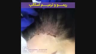 ریمو و ترمیم اسکالپ
