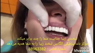 فیلم لمینیت دندان | فیلم مراحل لمینیت دندان | تفاوت لمینیت سرامیکی با لمینیت کامپوزیتی | فرق ونیر کامپوزیت با پرسلن کامپوزیت