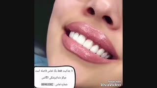 دندانپزشک زیبایی خیلی خوب | مزایای ونیر کامپوزیت | مزایای لمینیت کردن دندان | ماندگاری ونیر کامپوزیت بیشتر است یا لمینیت سرامیکی ترمیم سوختگی