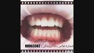 اصلاح طرح لبخند | راه های اصلاح طرح لبخند | بهترین روش اصلاح طرح لبخند | لبخند هالیوودی | اصلاح طرح لبخند با ونیر کامپوزیت