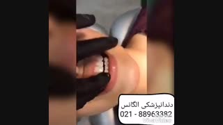 سفید کردن دندان | بلیچینگ دندان | بلیچ دندان با لیزر | کاشت نگین دندان | کاشت دندان | روکش دندان با زیرکونیا ترمیم لبخند لثه‌ای