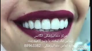 عصب کشی دندان | روت کانال دندان | اندو | مراحل عصب کشی دندان | عصب کشی دندان بدون درد | پر کردن دندان با آمالگام