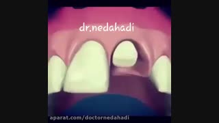 روش کاشت ایمپلنت دندان