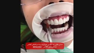 قیمت ونیر کامپوزیت | قیمت لمینیت دندان | قیمت لمینیت سرامیکی | هزینه لمینیت کردن دندان | هزینه کامپوزیت کردن دندان