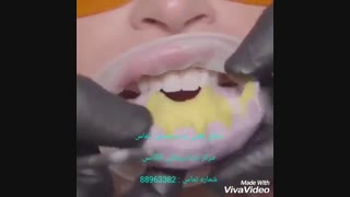 ایا لمینیت کردن دندان درد دارد | درد در هنگام لمینیت کردن دندان | علت تراش دادن دندان برای لمینیت سرامیکی