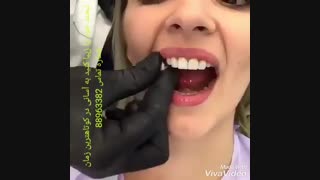 لمینیت سرامیکی بهتر است یا ونیر کامپوزیت | تفاوت لمینیت سرامیکی با لمینیت کامپوزیتی | مدل های مختلف لمینیت دندان