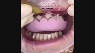 فیلم لمینیت کردن دندان | فیلم ترمیم لمینیت دندان | فیلم ترمیم ونیر کامپوزیت | فیلم چسباندن ونیر کامپوزیت | لامینیت دندان چیست