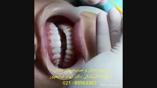 ترمیم دندان شکسته | علت شکستن لمینیت سرامیکی | علت شکستن لمینیت کامپوزتی | علت تغییر رنگ لمینیت های دندانی