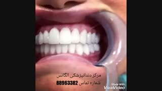 شرایط لمینیت کردن دندان | آیا دندان پر شده را میشود لمینیت کرد | کامپوزیت کردن دندان های پر شده | ترک خوردن لمینیت دندان