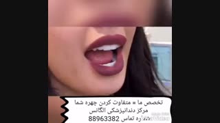 کامپوزیت های زیبایی دندان | طریقه ساخت لمینیت سرامیکی | مراحل ساخت لمینیت سرامیکی | فیلم چسباندن لمینیت دندان