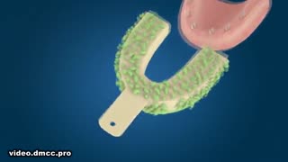 مراحل ساخت روکش دندان بعد از ایمپلنت|کلینیک دندانپزشکی مدرن