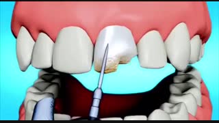 باندینگ دندان