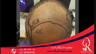 کاشت مو | فیلم کاشت مو | کلینیک پوست و مو رز | شماره 20