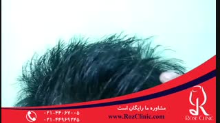 کاشت مو | فیلم کاشت مو | کلینیک پوست و مو رز | شماره 19