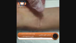 از بین بردن اسکار