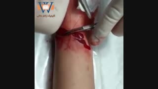 درمان اسکار زخم