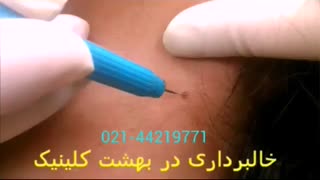 برداشتن خال بدون جراحی