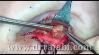 تخلیه ژل و چربی تزریق شده زیر چشم رفع افتادگی پلک