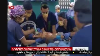جداسازی دوقلو ها