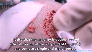 فیلم کامل کاشت مو به روش FUE