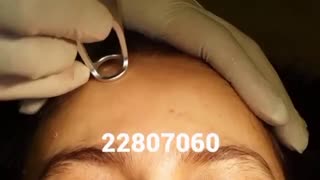 لیزر جوانسازی - کلینیک زیبایی پری سیما - 22807060 اندودنتیکس