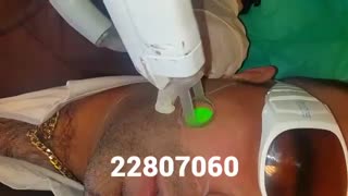 لیزر موهای زائد - کلینیک زیبایی پری سیما - 22807060