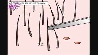 پیوند مو یا کاشت مو مشهد