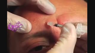 بوتاکس رفع چین و چروک صورت کاشت ریش