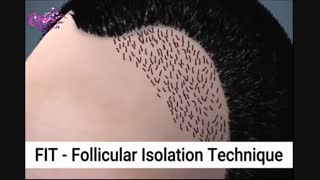 کاشت مو مشهد