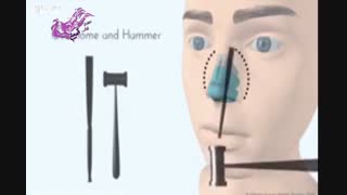 جراحی بینی استخوانی در مشهد