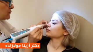 پلاسما جت، فرم دهی بینی بدون جراحی جراحی زیبایی پلک